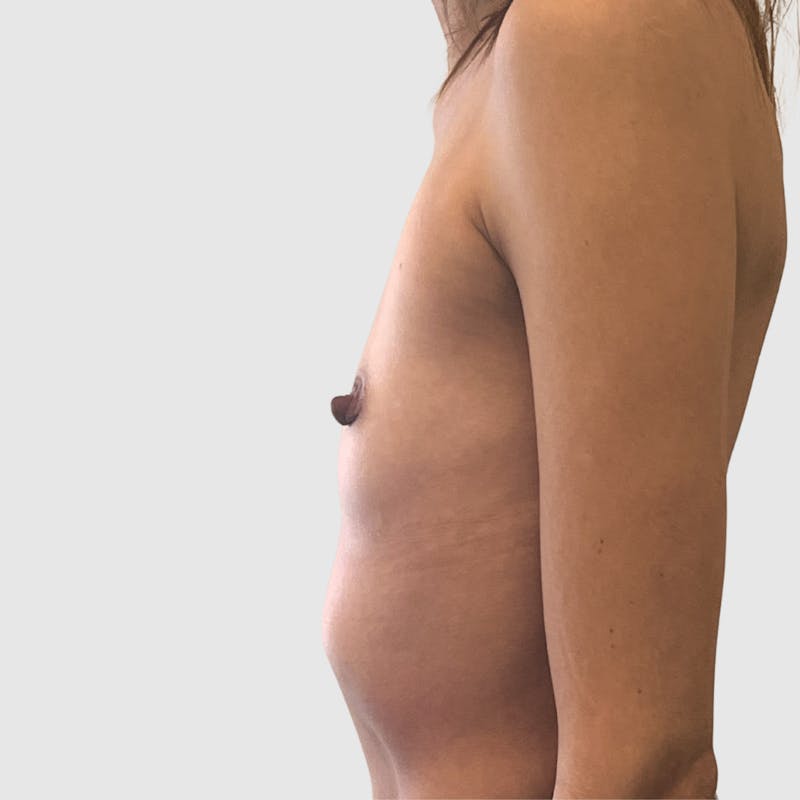 Breast Augmentation Before & After Gallery - Patient 338518 - Image 5
