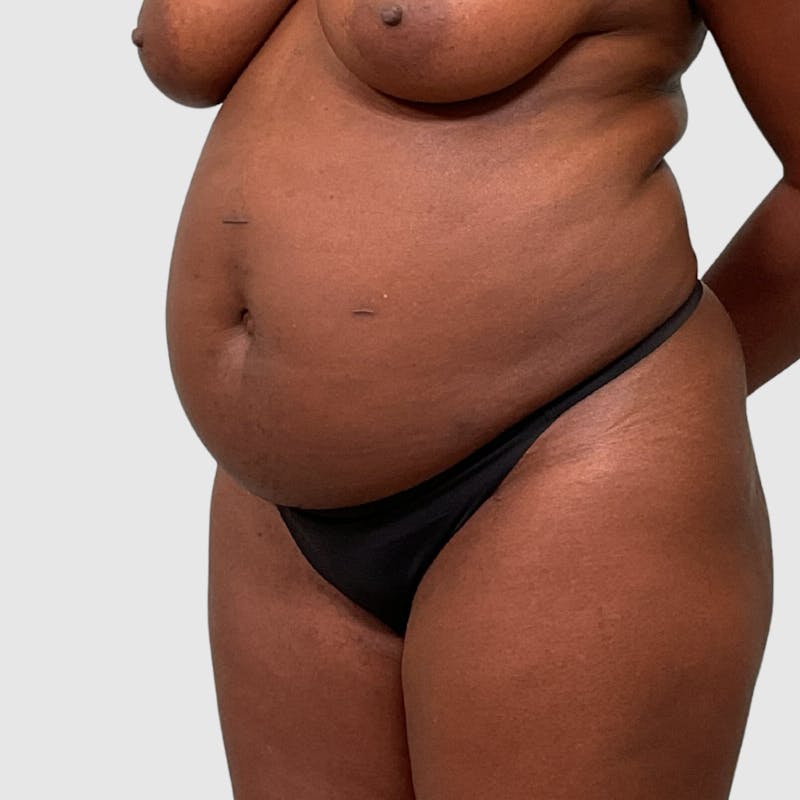 Tummy Tuck Before & After Gallery - Patient 355045 - Image 3