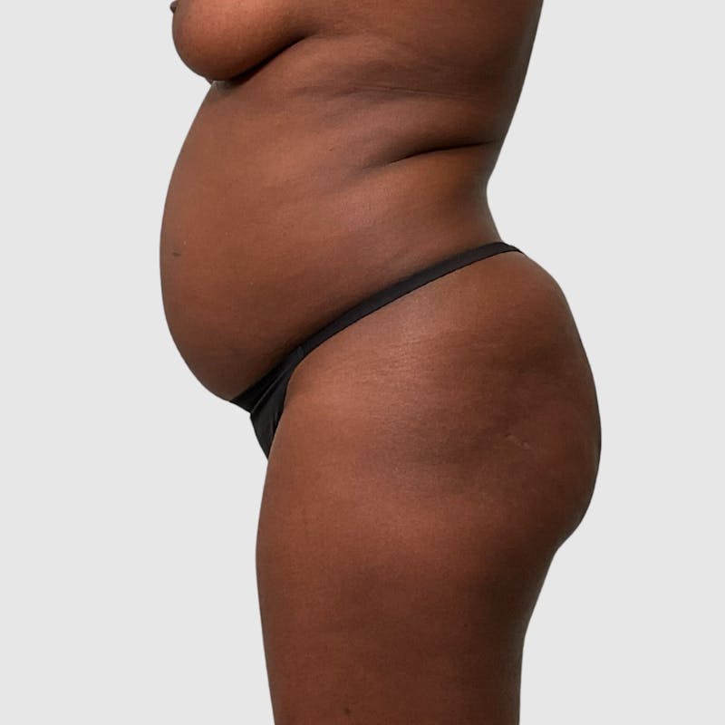 Tummy Tuck Before & After Gallery - Patient 355045 - Image 5
