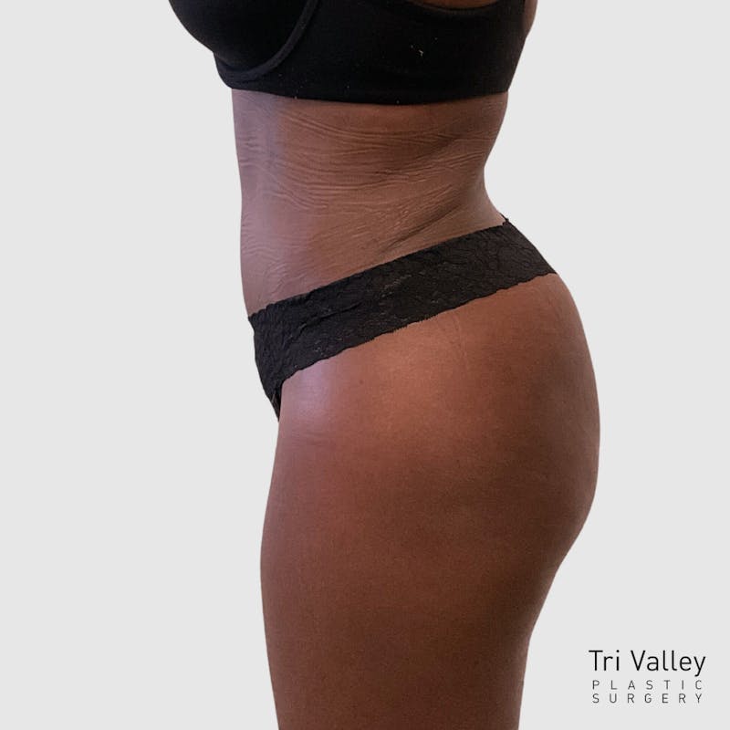 Tummy Tuck Before & After Gallery - Patient 355045 - Image 6
