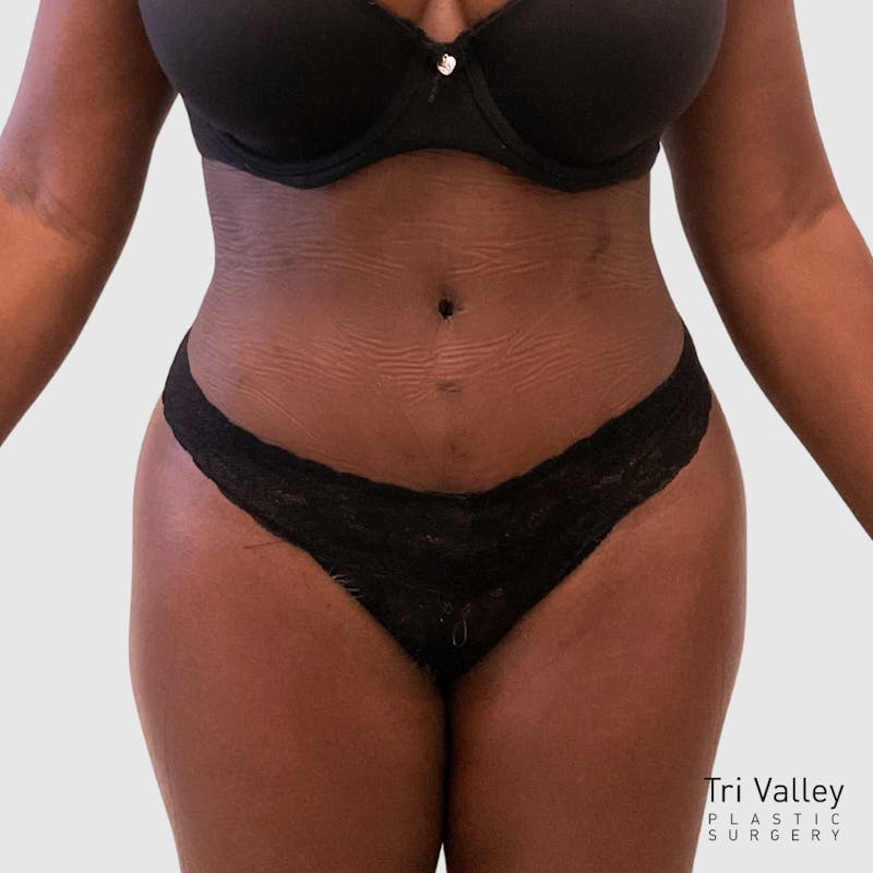 Brazilian Butt Lift Before & After Gallery - Patient 306809 - Image 4