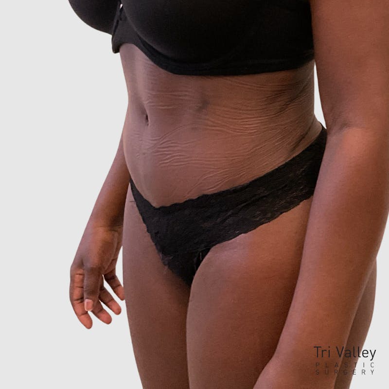 Tummy Tuck Before & After Gallery - Patient 355045 - Image 4