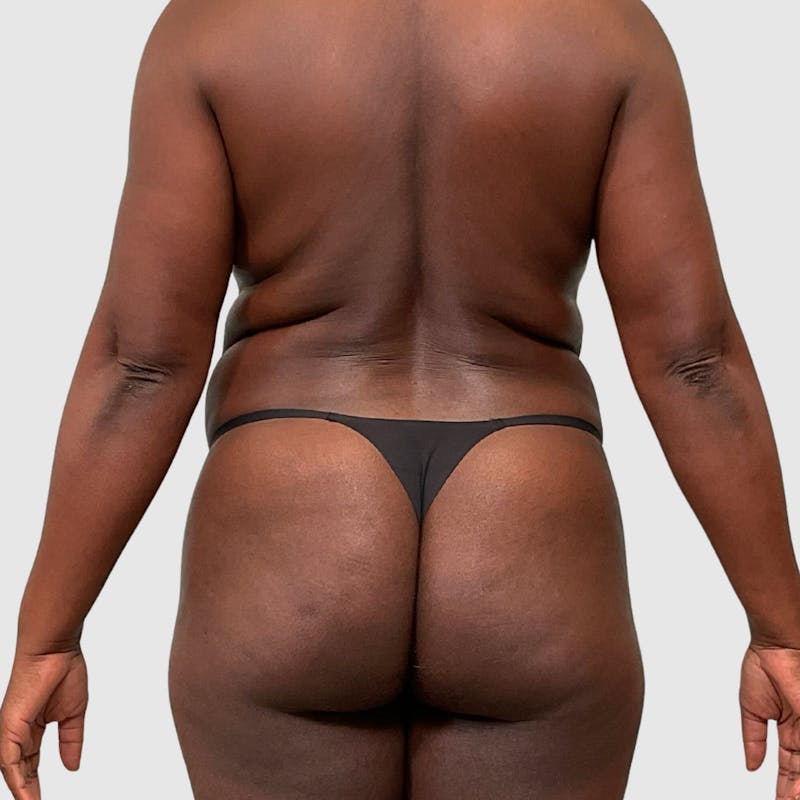 Tummy Tuck Before & After Gallery - Patient 355045 - Image 7
