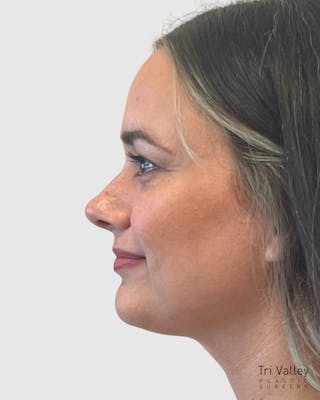Rhinoplasty Before & After Gallery - Patient 152331 - Image 2