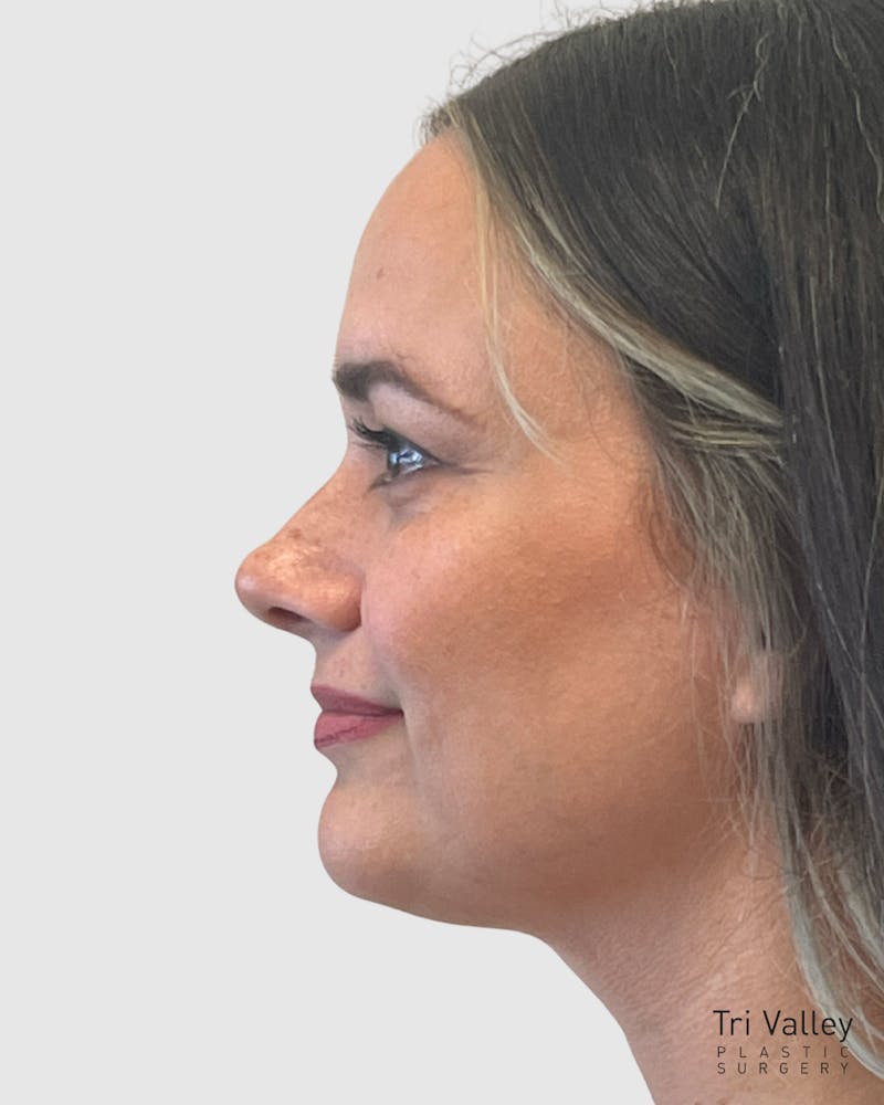 Rhinoplasty Before & After Gallery - Patient 152331 - Image 2