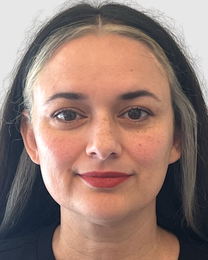 Rhinoplasty Before & After Gallery - Patient 152331 - Image 3