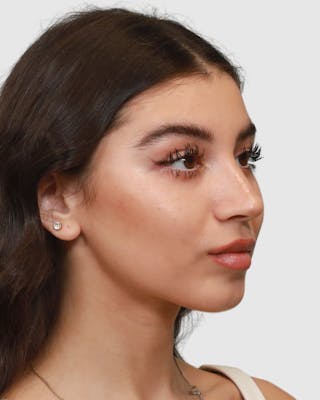 Rhinoplasty Before & After Gallery - Patient 268724 - Image 2