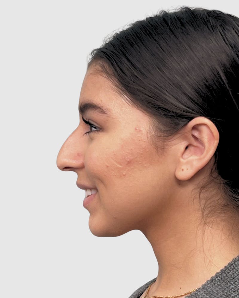 Rhinoplasty Before & After Gallery - Patient 268724 - Image 3