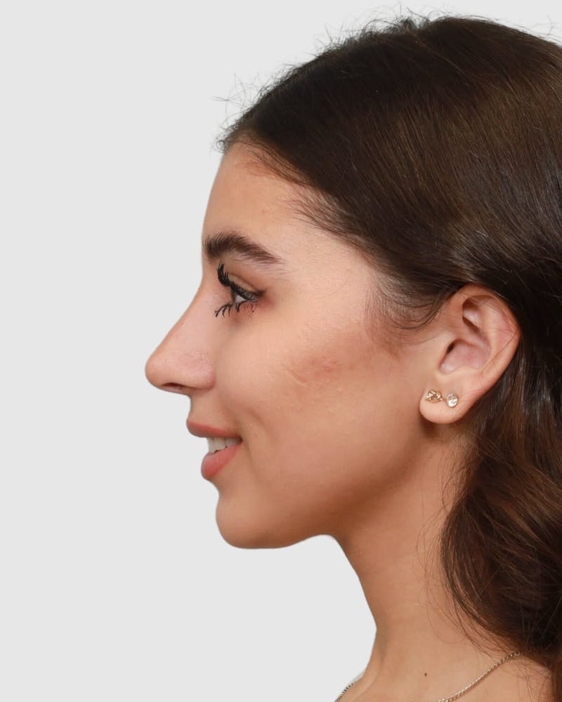 Rhinoplasty Before & After Gallery - Patient 268724 - Image 4