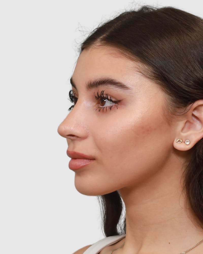 Rhinoplasty Before & After Gallery - Patient 268724 - Image 6