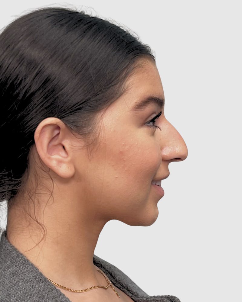 Rhinoplasty Before & After Gallery - Patient 268724 - Image 7