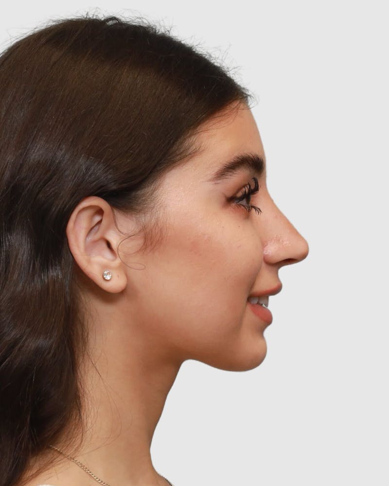 Rhinoplasty Before & After Gallery - Patient 268724 - Image 8