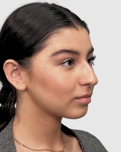 Rhinoplasty Before & After Gallery - Patient 268724 - Image 1