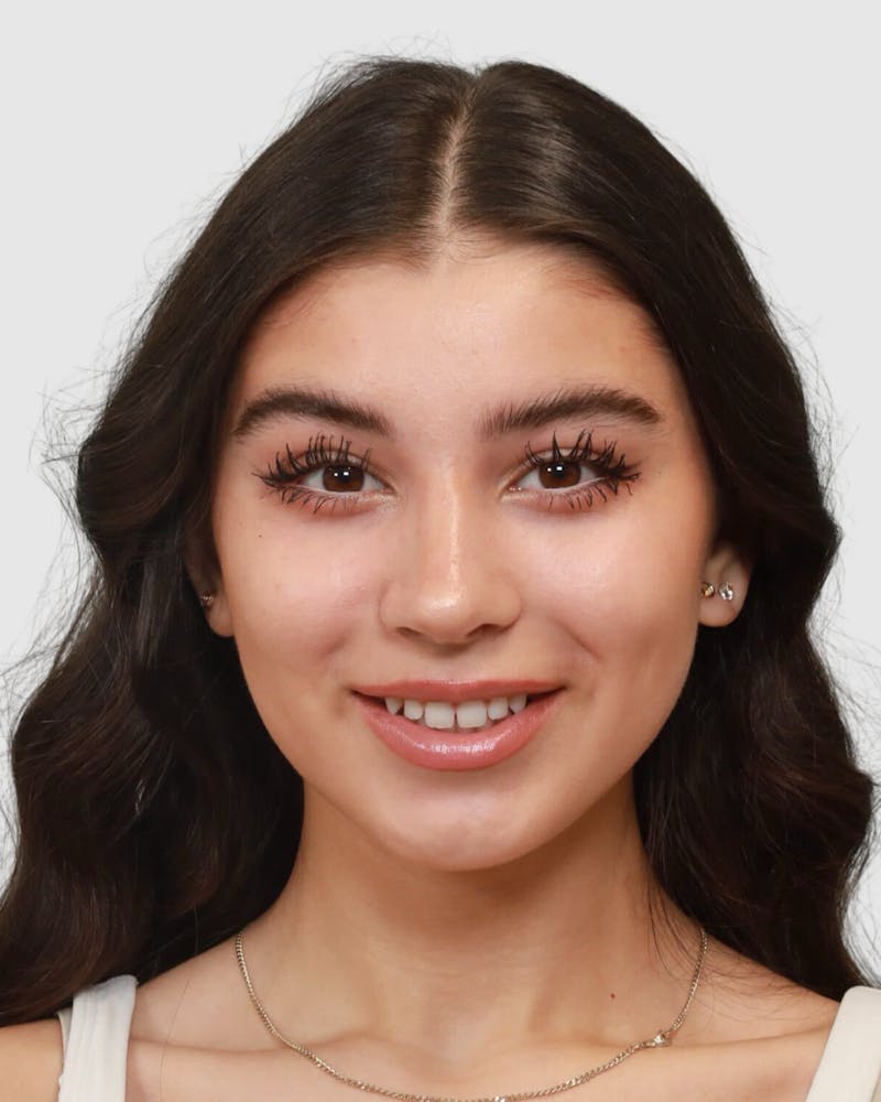 Rhinoplasty Before & After Gallery - Patient 268724 - Image 10