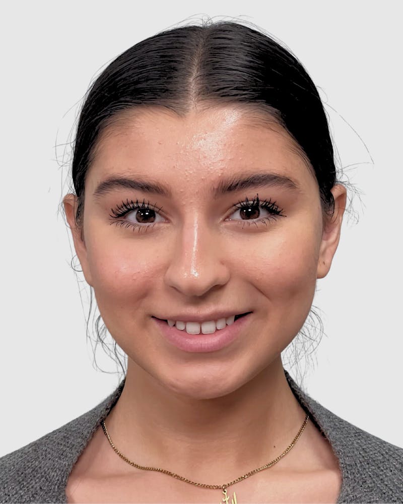 Rhinoplasty Before & After Gallery - Patient 268724 - Image 9