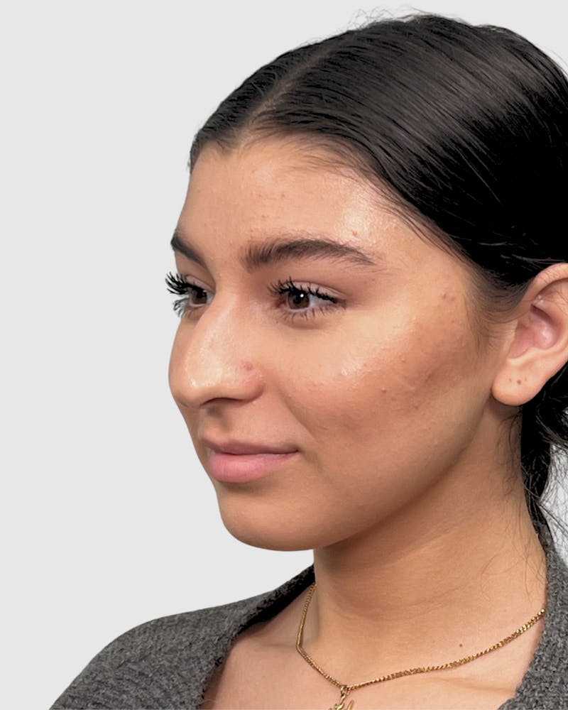 Rhinoplasty Before & After Gallery - Patient 268724 - Image 5