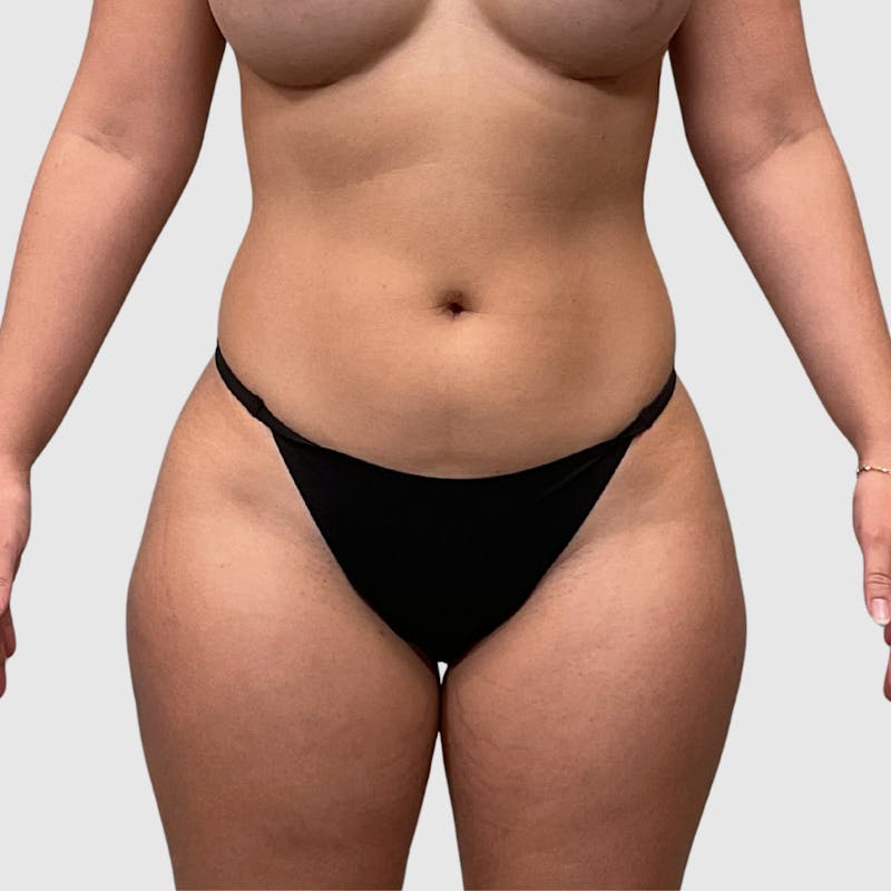 Liposuction Before & After Gallery - Patient 318768 - Image 1