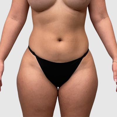 Liposuction Before & After Gallery - Patient 318768 - Image 1
