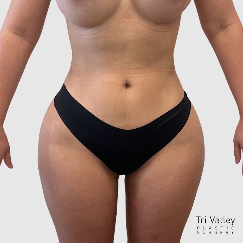 Liposuction Before & After Gallery - Patient 318768 - Image 2