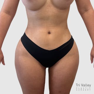 Liposuction Before & After Gallery - Patient 318768 - Image 2