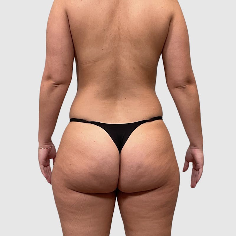 Liposuction Before & After Gallery - Patient 318768 - Image 7