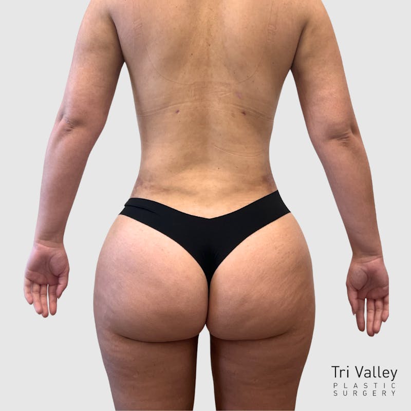 Liposuction Before & After Gallery - Patient 318768 - Image 8