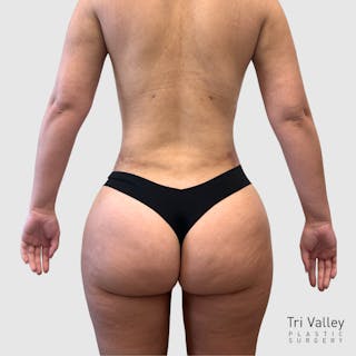 Liposuction Before & After Gallery - Patient 318768 - Image 8