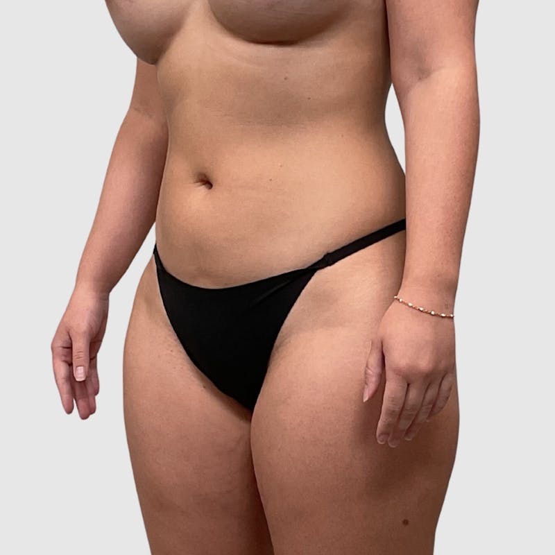 Liposuction Before & After Gallery - Patient 318768 - Image 3