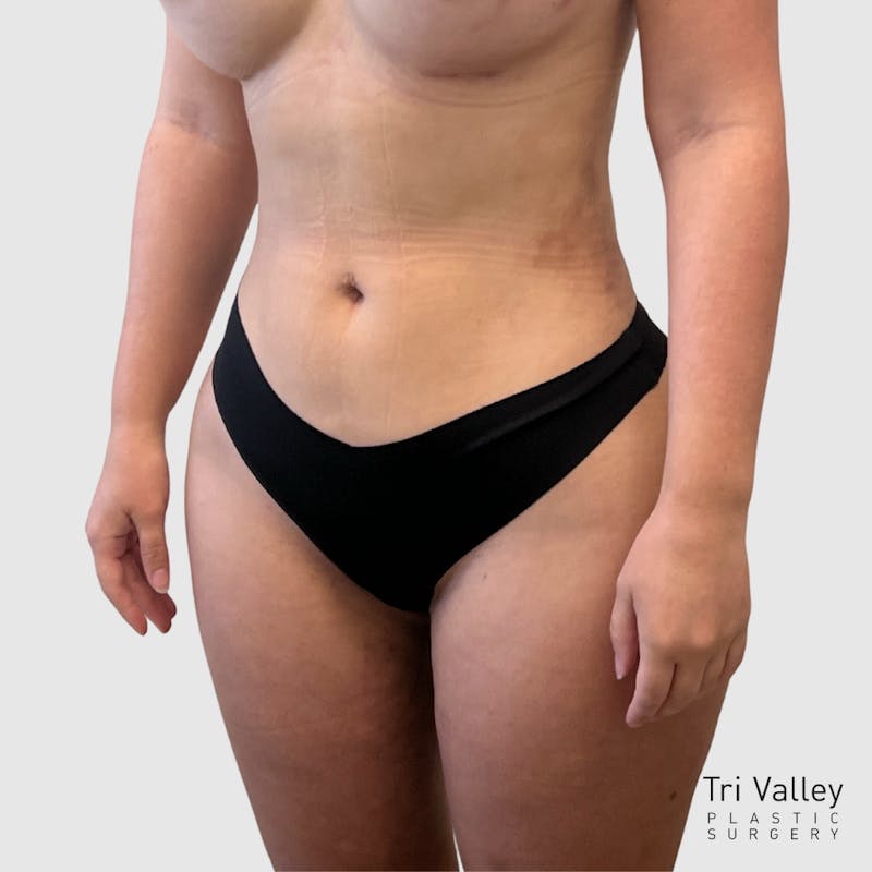 Liposuction Before & After Gallery - Patient 318768 - Image 4