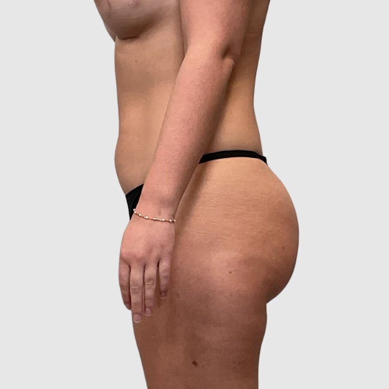 Liposuction Before & After Gallery - Patient 318768 - Image 5