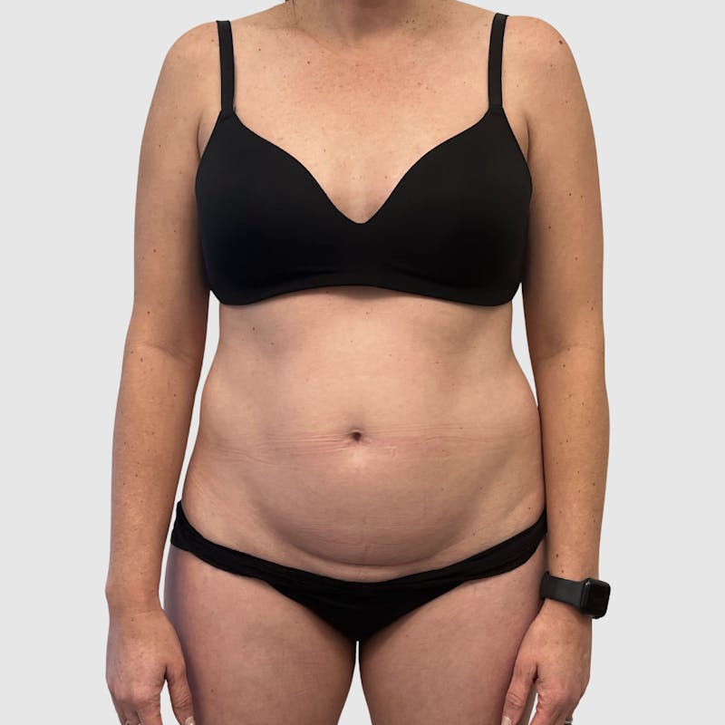 Liposuction Before & After Gallery - Patient 679146 - Image 1
