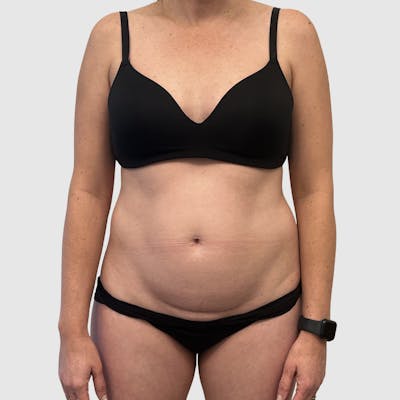 Liposuction Before & After Gallery - Patient 679146 - Image 1