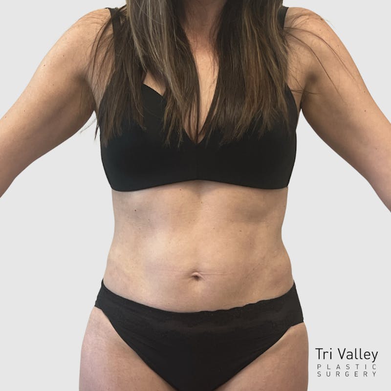 Liposuction Before & After Gallery - Patient 679146 - Image 2