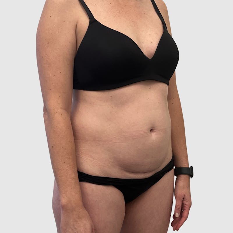 Liposuction Before & After Gallery - Patient 679146 - Image 3