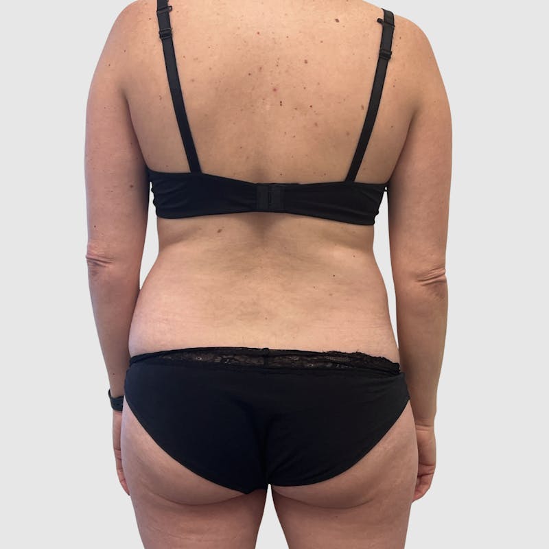 Liposuction Before & After Gallery - Patient 679146 - Image 5