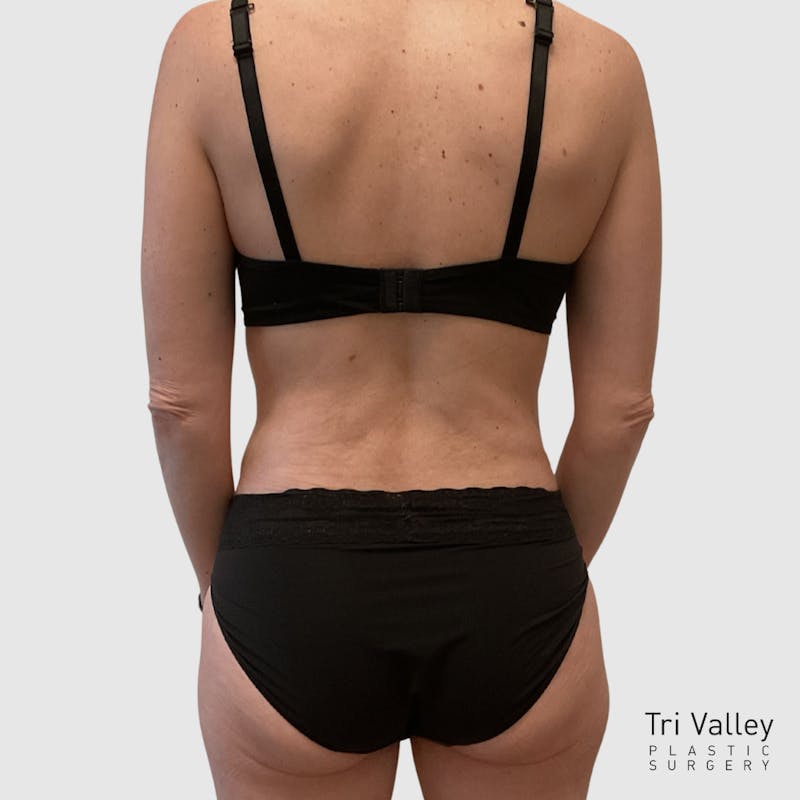 Liposuction Before & After Gallery - Patient 679146 - Image 6