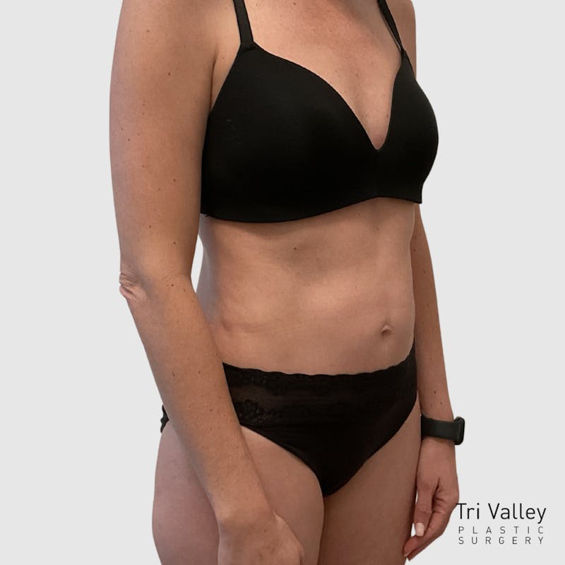 Liposuction Before & After Gallery - Patient 679146 - Image 4