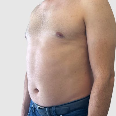 Liposuction Before & After Gallery - Patient 570016 - Image 1