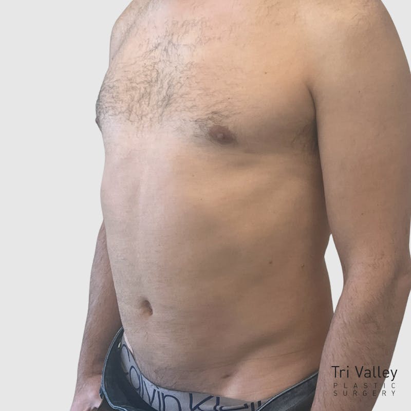 Liposuction Before & After Gallery - Patient 570016 - Image 4