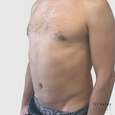 Liposuction Before & After Gallery - Patient 570016 - Image 2