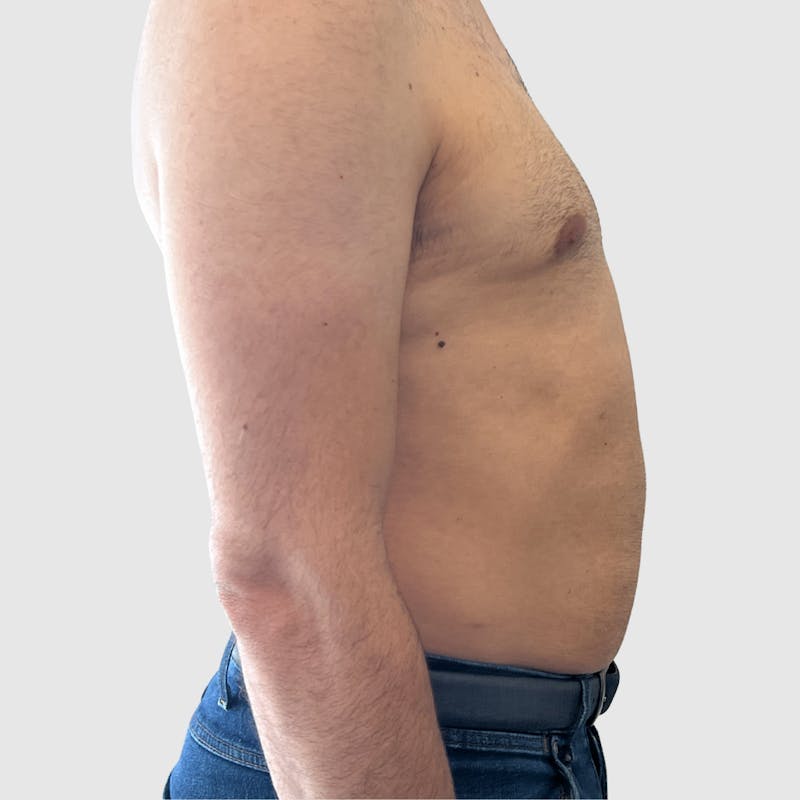 Liposuction Before & After Gallery - Patient 570016 - Image 5