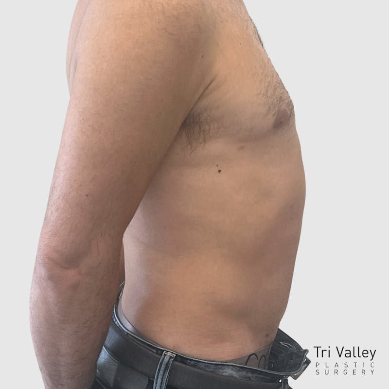 Liposuction Before & After Gallery - Patient 570016 - Image 6