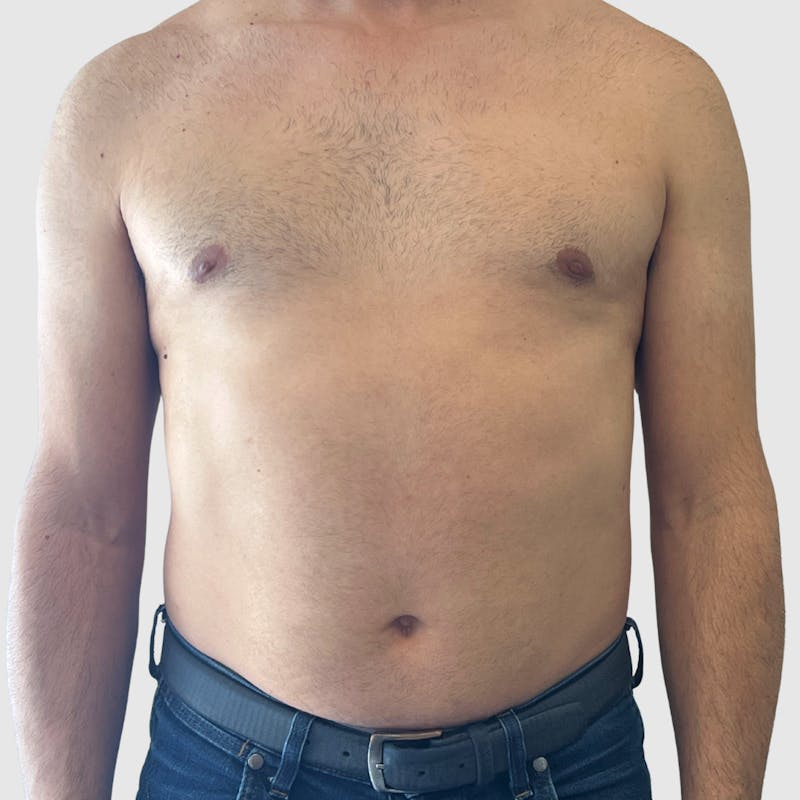 Liposuction Before & After Gallery - Patient 570016 - Image 1