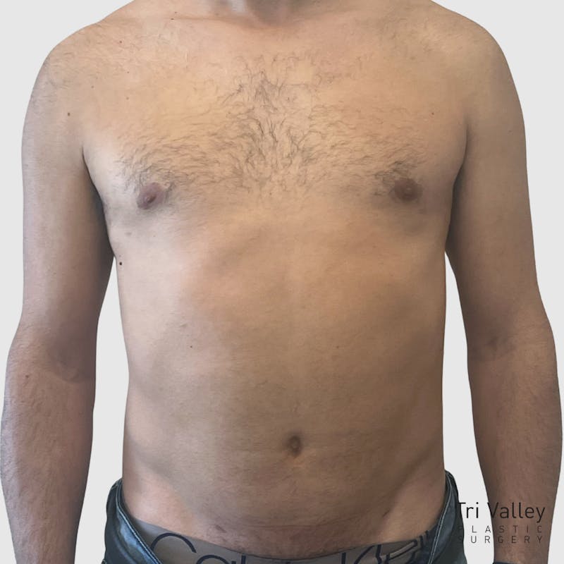 Liposuction Before & After Gallery - Patient 570016 - Image 2