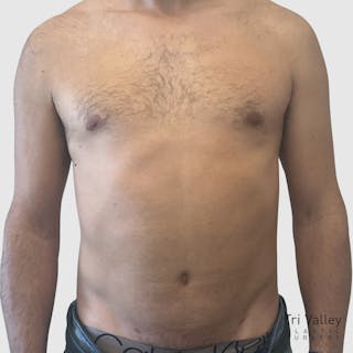 Liposuction Before & After Gallery - Patient 570016 - Image 2