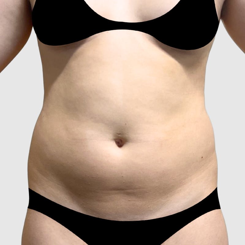 Liposuction Before & After Gallery - Patient 301688 - Image 1