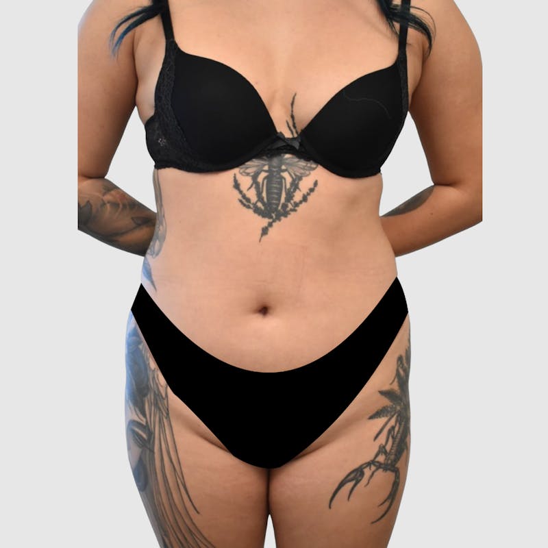 Liposuction Before & After Gallery - Patient 277191 - Image 1