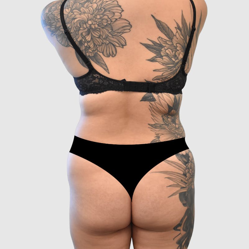 Liposuction Before & After Gallery - Patient 277191 - Image 3