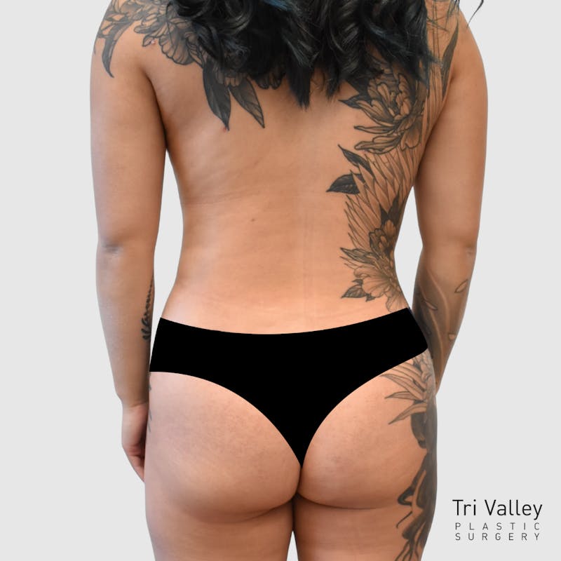 Liposuction Before & After Gallery - Patient 277191 - Image 4