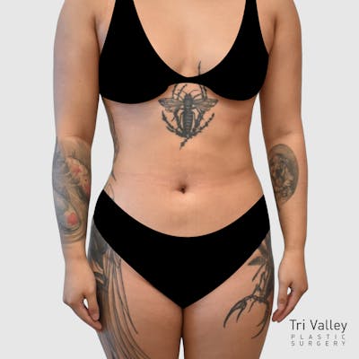 Liposuction Before & After Gallery - Patient 277191 - Image 2